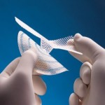 Prolene Mesh in Pakistan; Prevent Infection Postoperative Wounds Sterile Non Absorbable Material