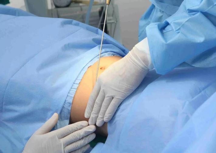 دستگاه لیپوساکشن چیست + قیمت خرید، کاربرد، مصارف و خواص