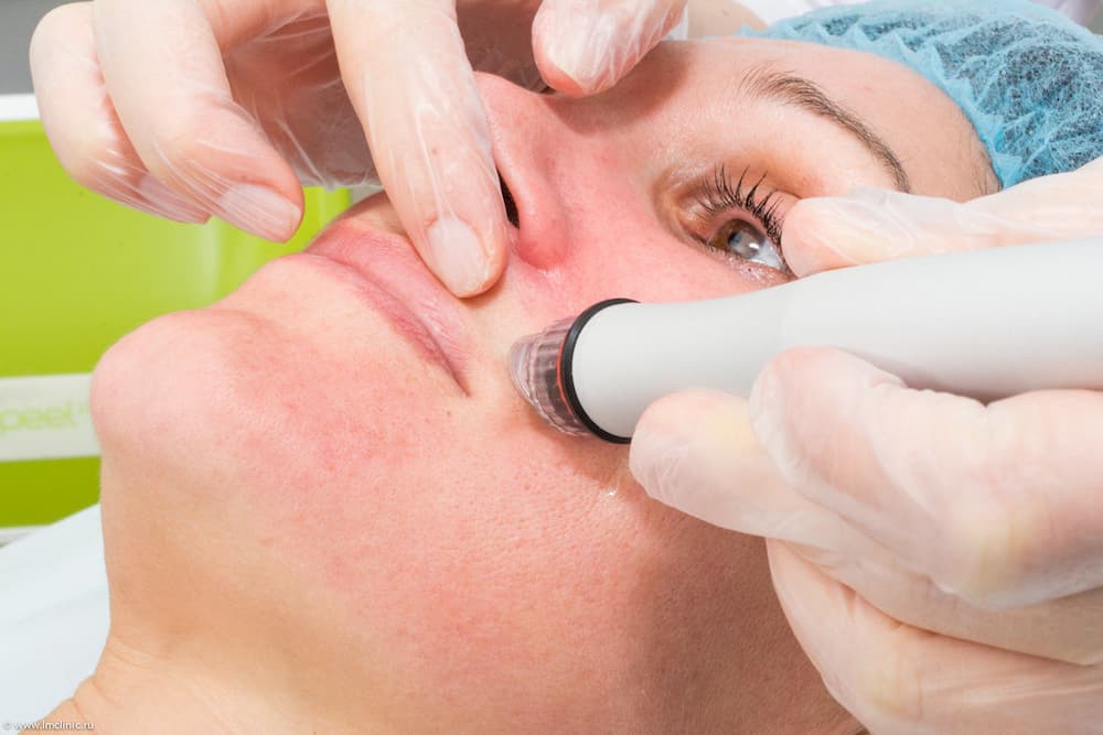 دستگاه پاکسازی میکرودرم (لایه برداری صورت) بهبود جوش سرسیاه و پوست آسیب دیده