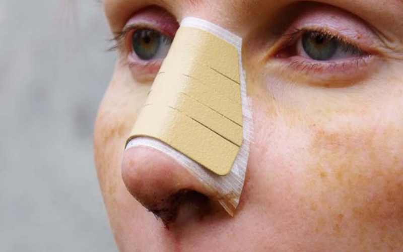 آتل بینی؛ سیلیکونی آلومینیومی انعطاف پذیر کاهش خونریزی