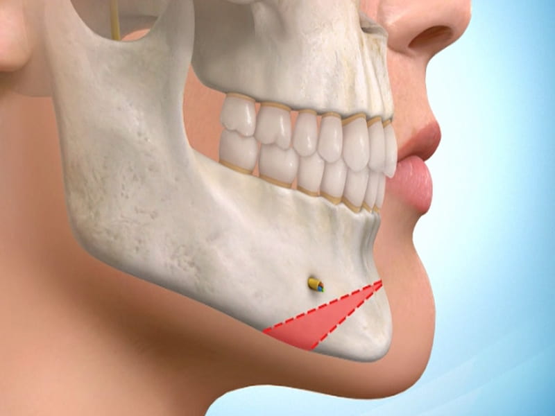 خرید و قیمت انواع ایمپلنت زاویه فک