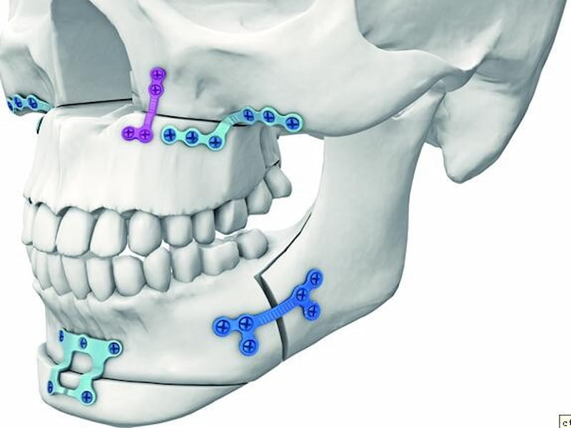 خرید انواع ایمپلنت کلی فک بالا + قیمت