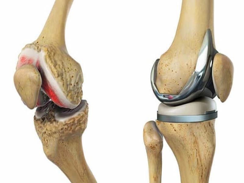 خرید انواع ایمپلنت استخوان پا + قیمت