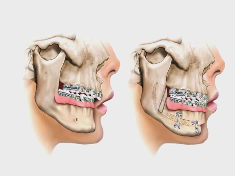 خرید ایمپلنت جراح فک + قیمت عالی