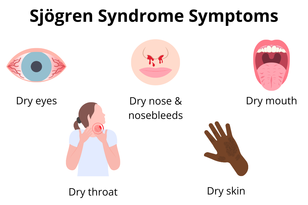 Chart showing common symptoms of Sjogren's syndrome including dry eyes, dry nose, dry mouth, dry throat and dry skin.