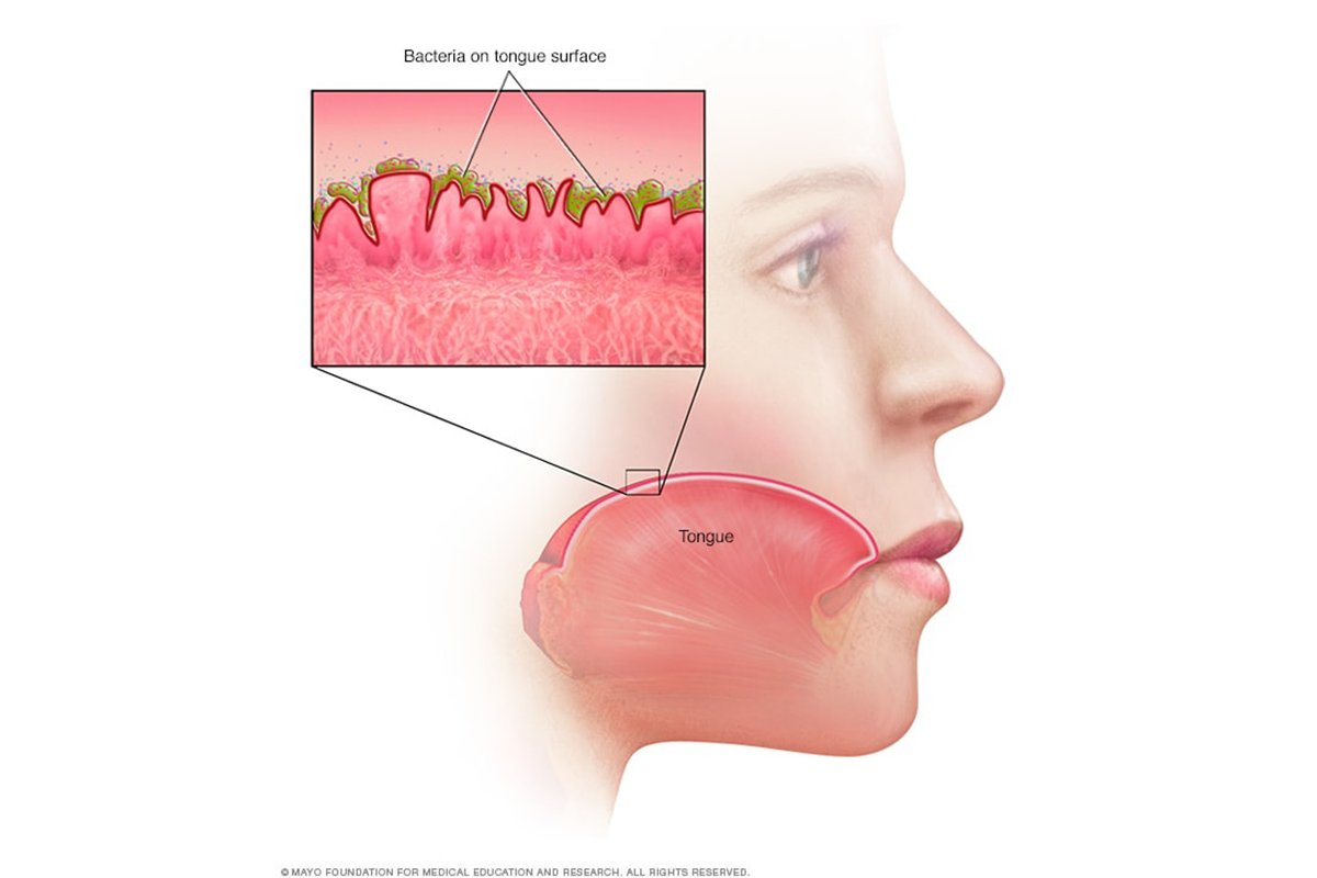 Diagram of the mouth showing close-up view of bacteria inside tongue grooves.