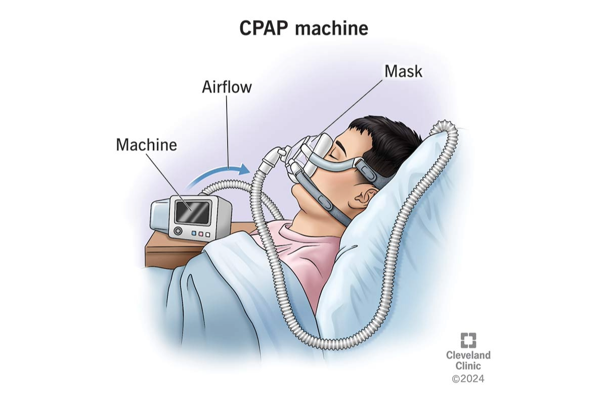 Full face CPAP machine diagram showing the machine, airflow and mask components in use.