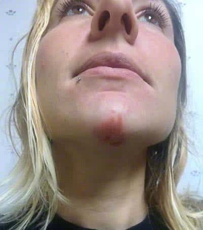 poison ivy rash on face