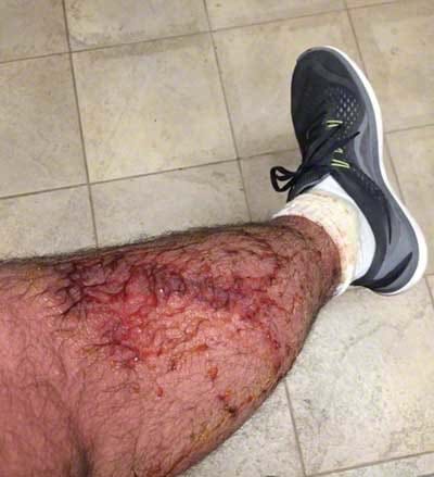 poison ivy rash on leg 