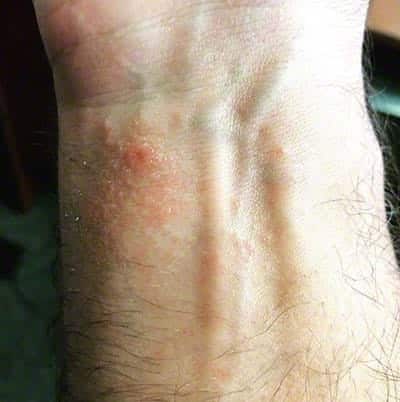 poison ivy rash on wrist