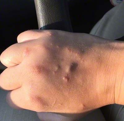 poison ivy rash on hand