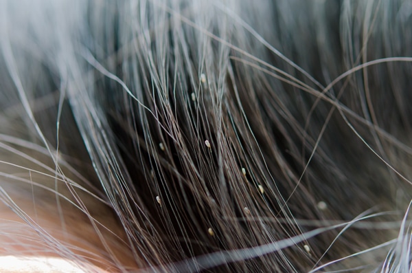 close up of nits in hair