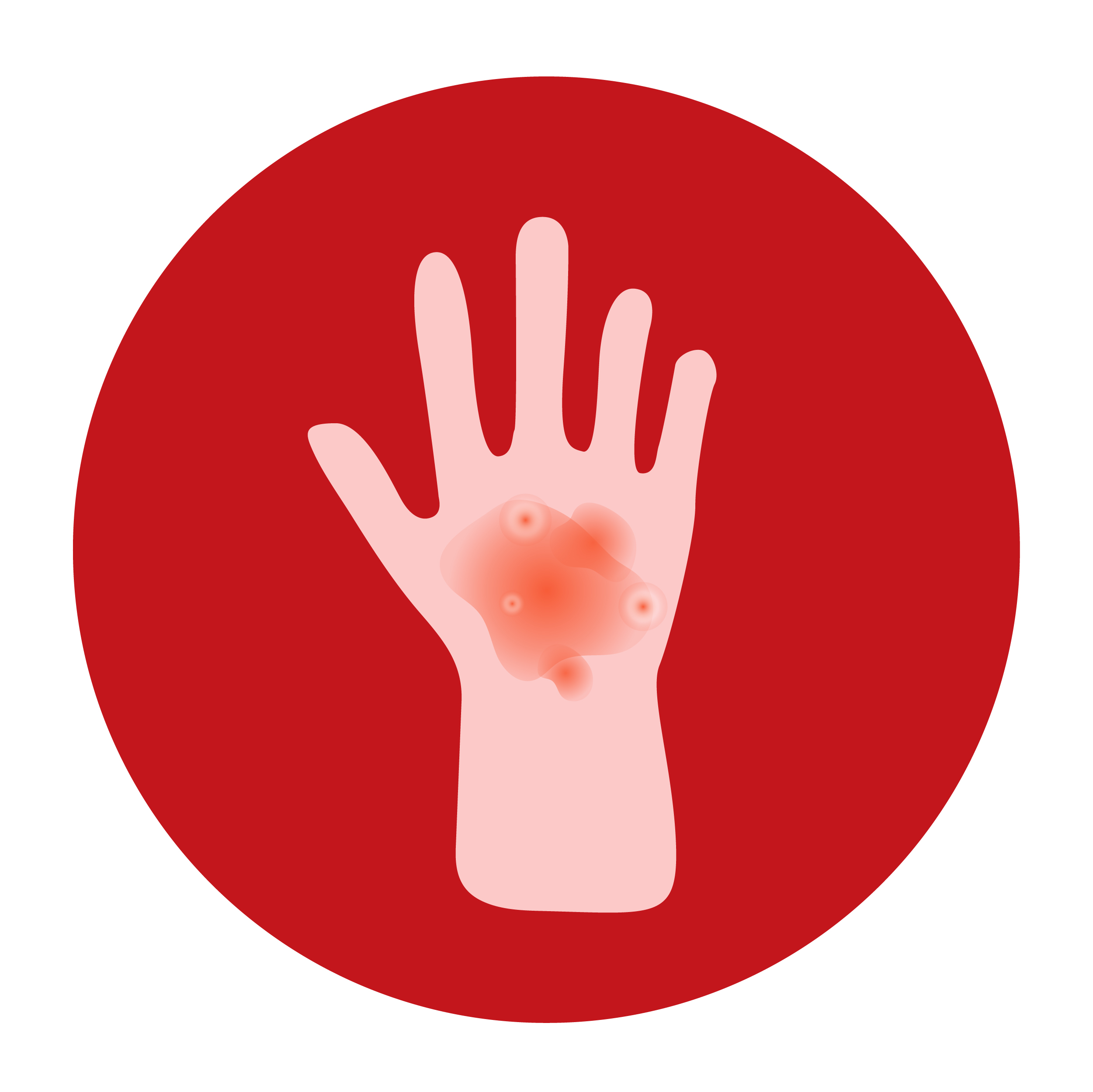 Second-Degree Burn on Forearm