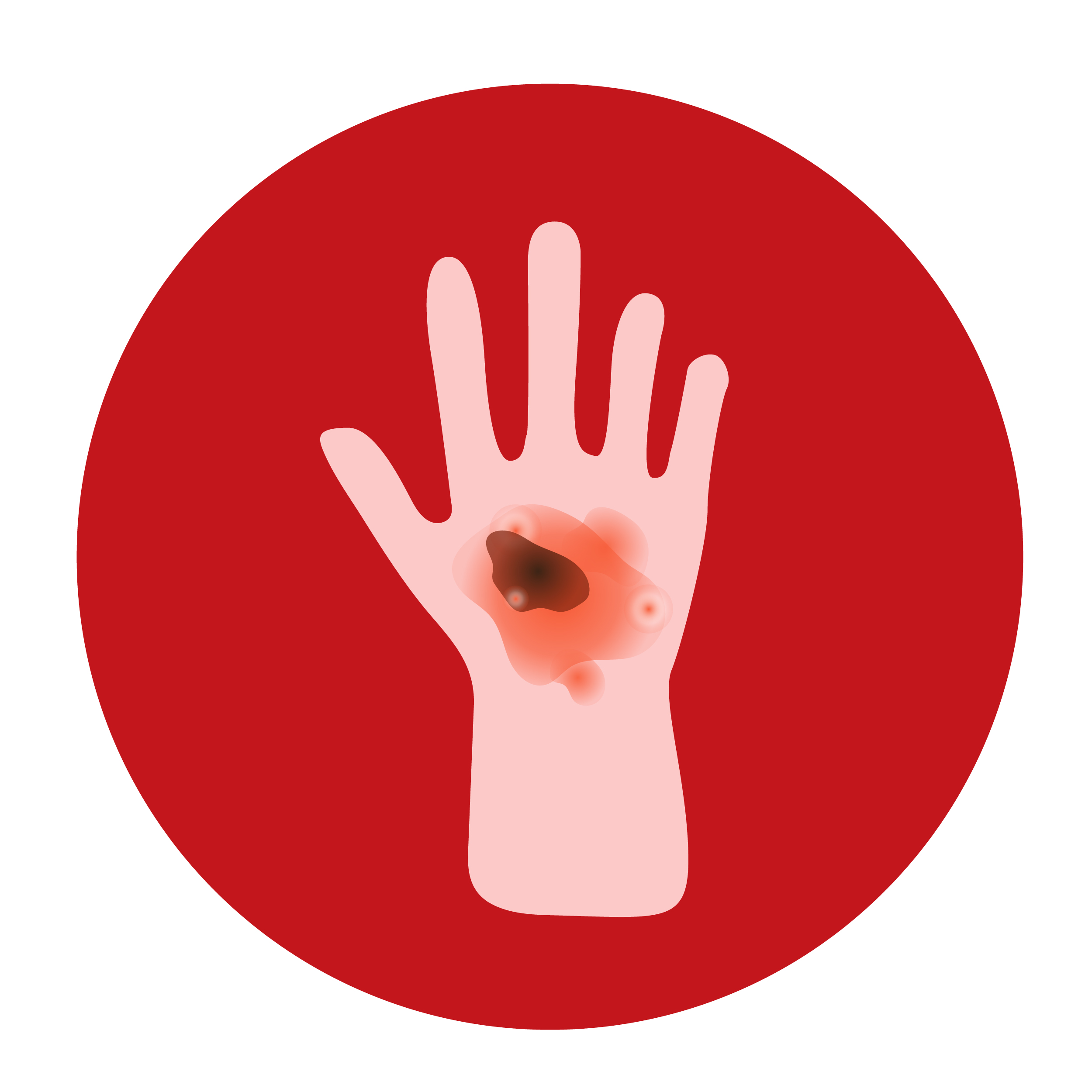 Third-Degree Burn on Right Side of Torso