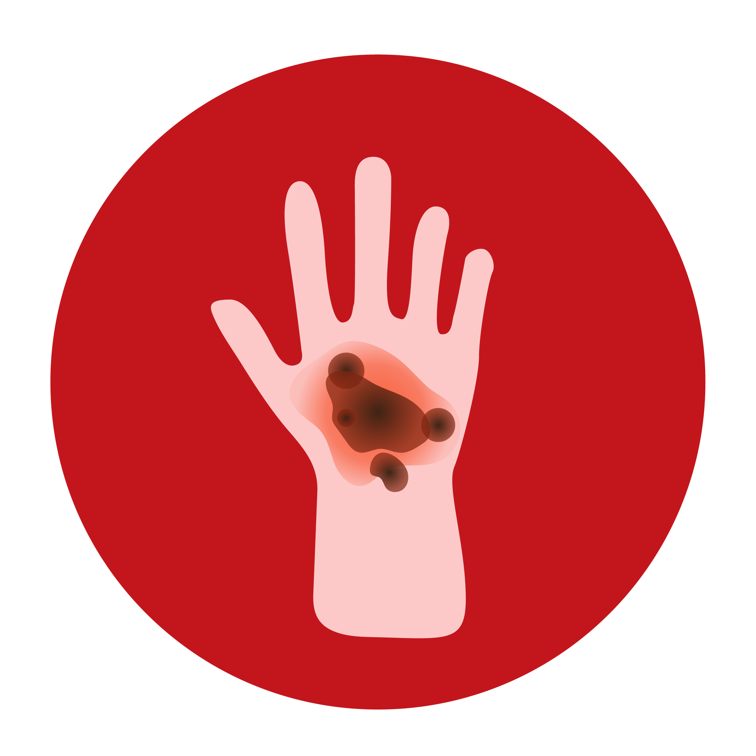 Fourth-Degree Burn on Top of Hand
