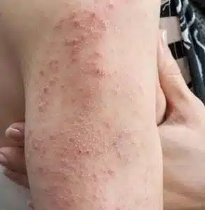 Contact Dermatitis on leg