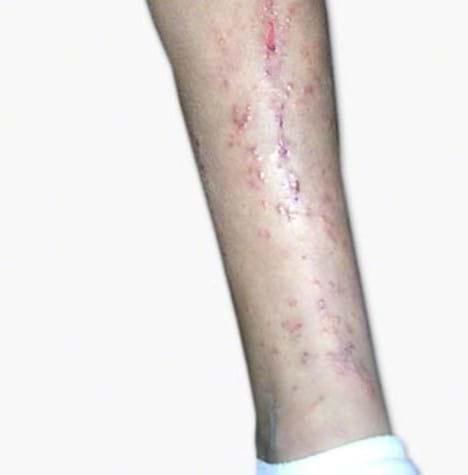 Poison ivy rash on a leg