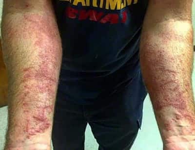 poison ivy rash on two arms