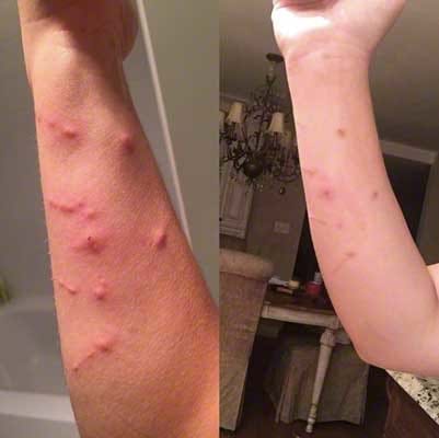 poison ivy rash on back of arm