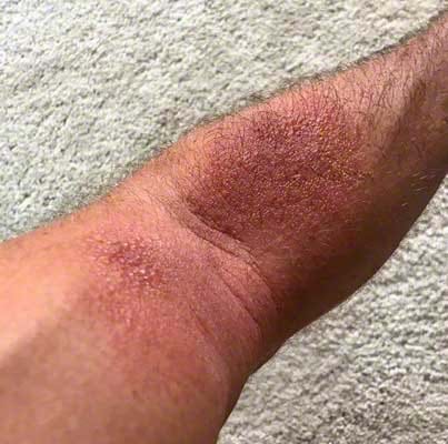 poison ivy rash on one arm
