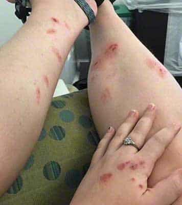 poison ivy rash on two legs