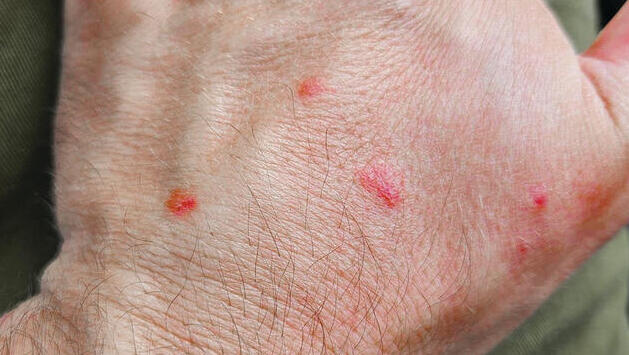 مئات الجنود الذين لدغتهم حشرات الفراش في غزة: "يعيشون في ظروف قذرة ويؤدون عملهم على أكمل وجه"