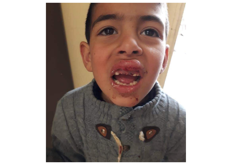 An Israeli settler ran over a 6-year-old Palestinian in Hebron