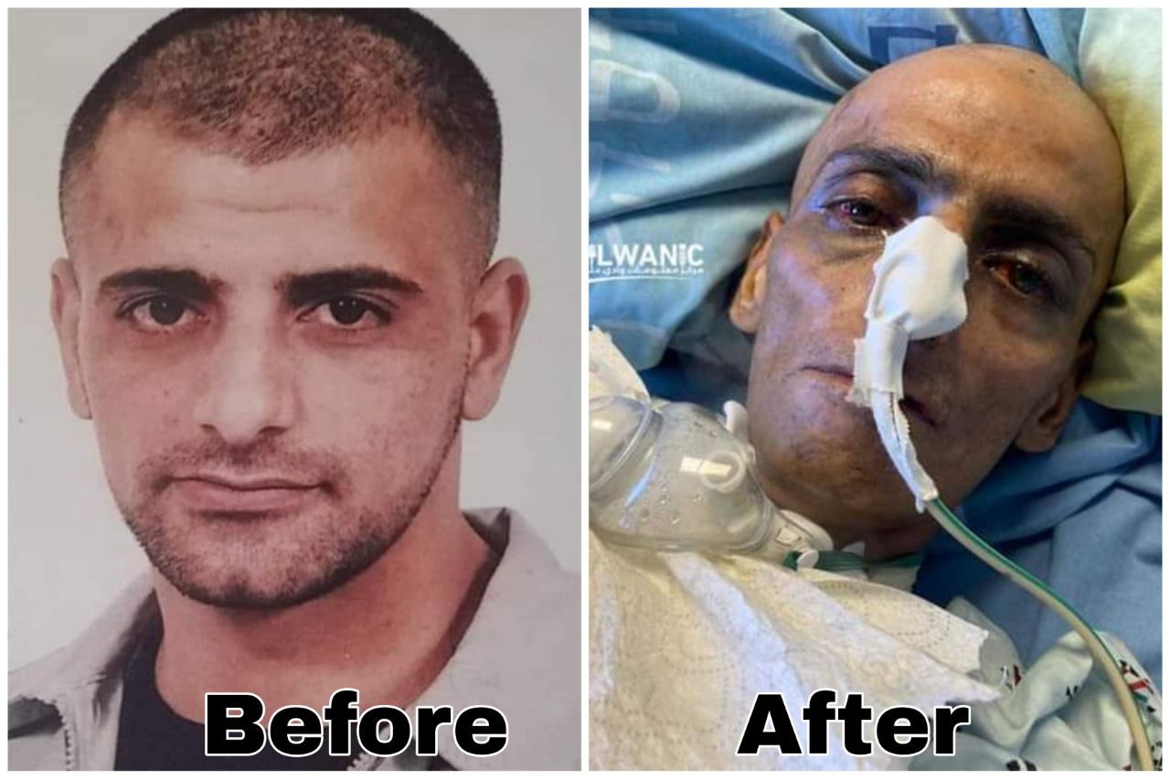 Due to medical negligence, Palestinian ex-detainee in Israeli jails dies of leukemia