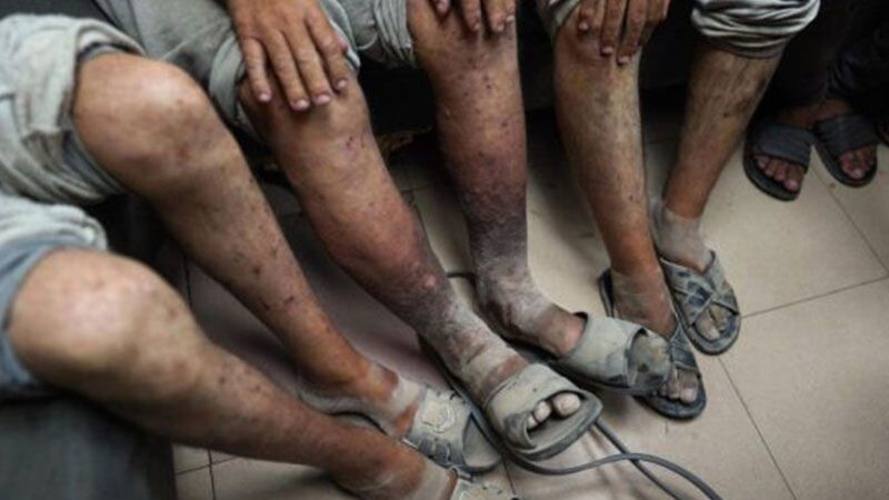 Israeli Media Expose Prison Service's Role in Spreading Scabies Among Palestinian Prisoners