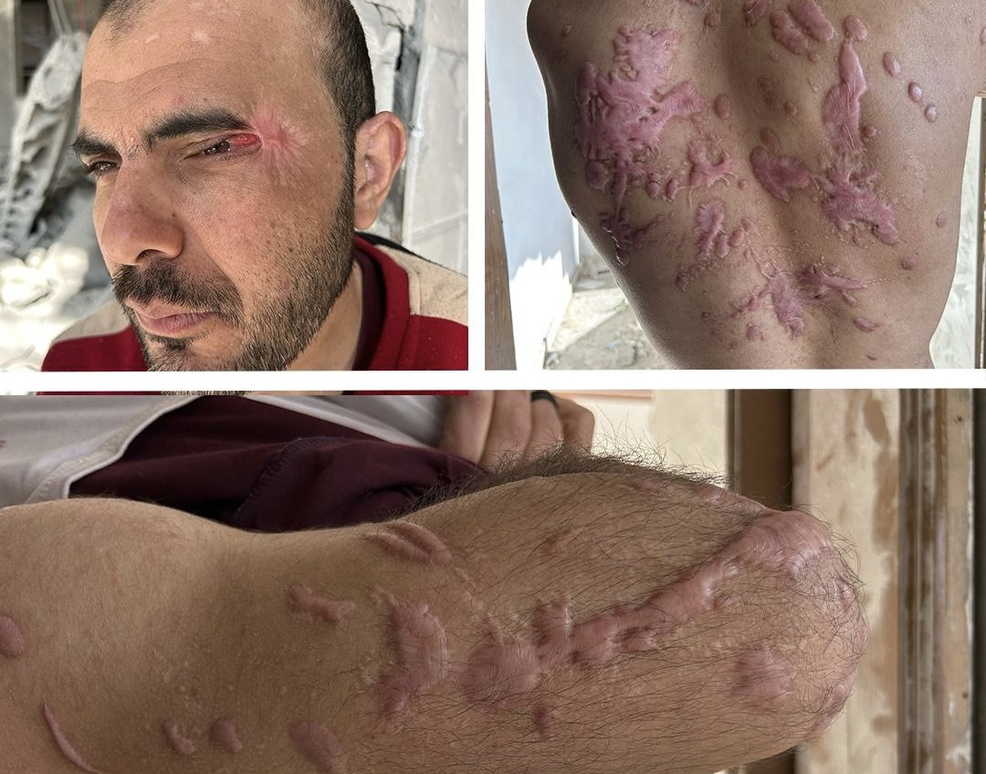 Freed Palestinian Detainee Recounts Abduction and Torture by Israeli Soldiers, Including Acid Being Poured on His Body