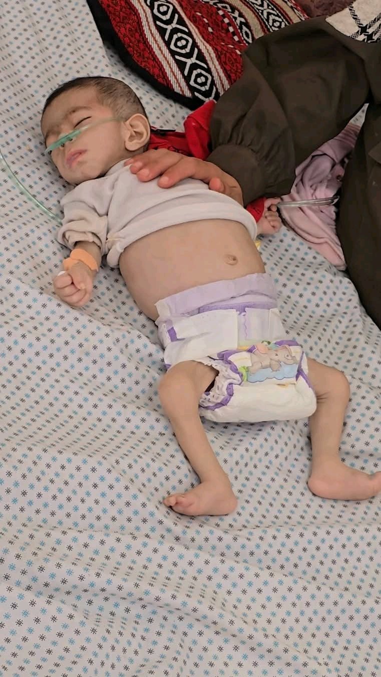 Baby Girl Dies Due to Malnutrition in Gaza Amid Israel’s Ongoing Blockade
