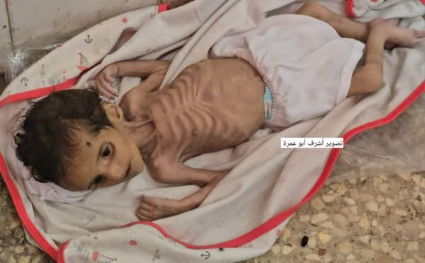 Child Deaths from Hunger Rise to 66 in Gaza as Israel Blocks Baby Formula and Aid