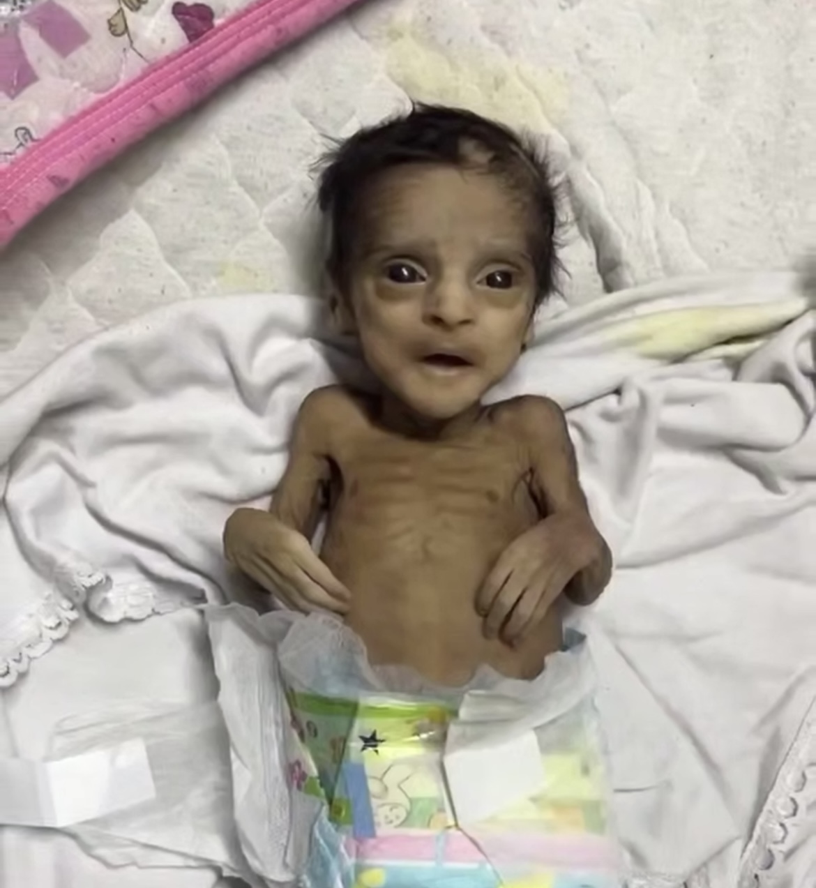 Two-Month-Old Infant Dies of Malnutrition in Gaza Amid Israeli Blockade
