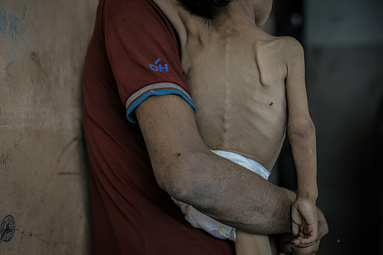 17,000 Children Starving in Gaza: Israeli-Made Famine Pushes People to Collapse in the Streets