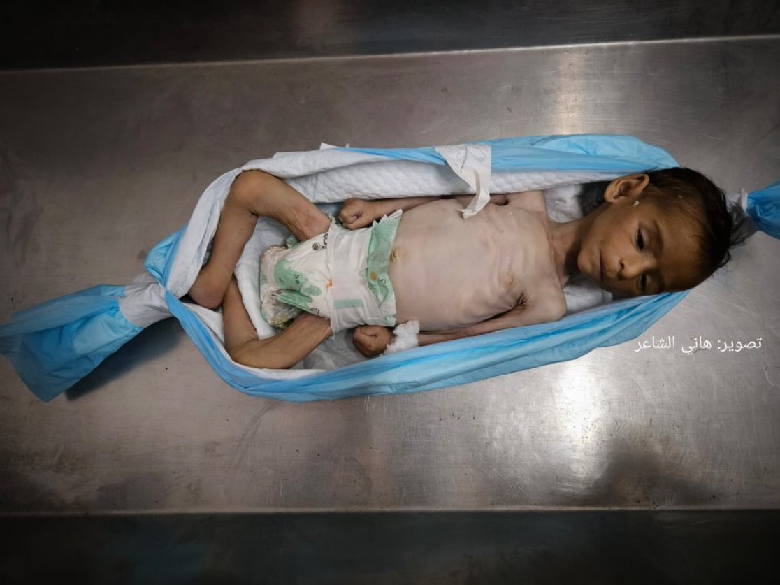 Second Child Dies of Hunger in Gaza Today as Israeli-Made Famine Deepens