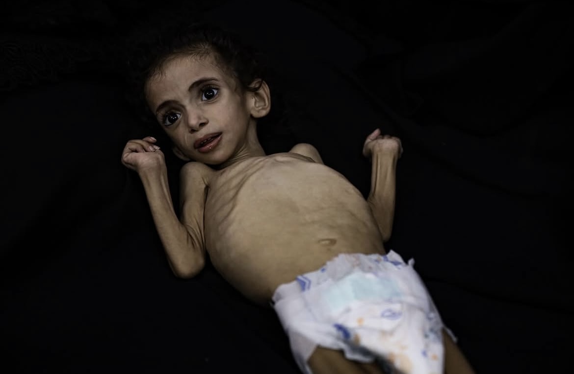 Gaza: 4-Year-Old Palestinian Girl Dies from Malnutrition as Israeli Blockade Continues
