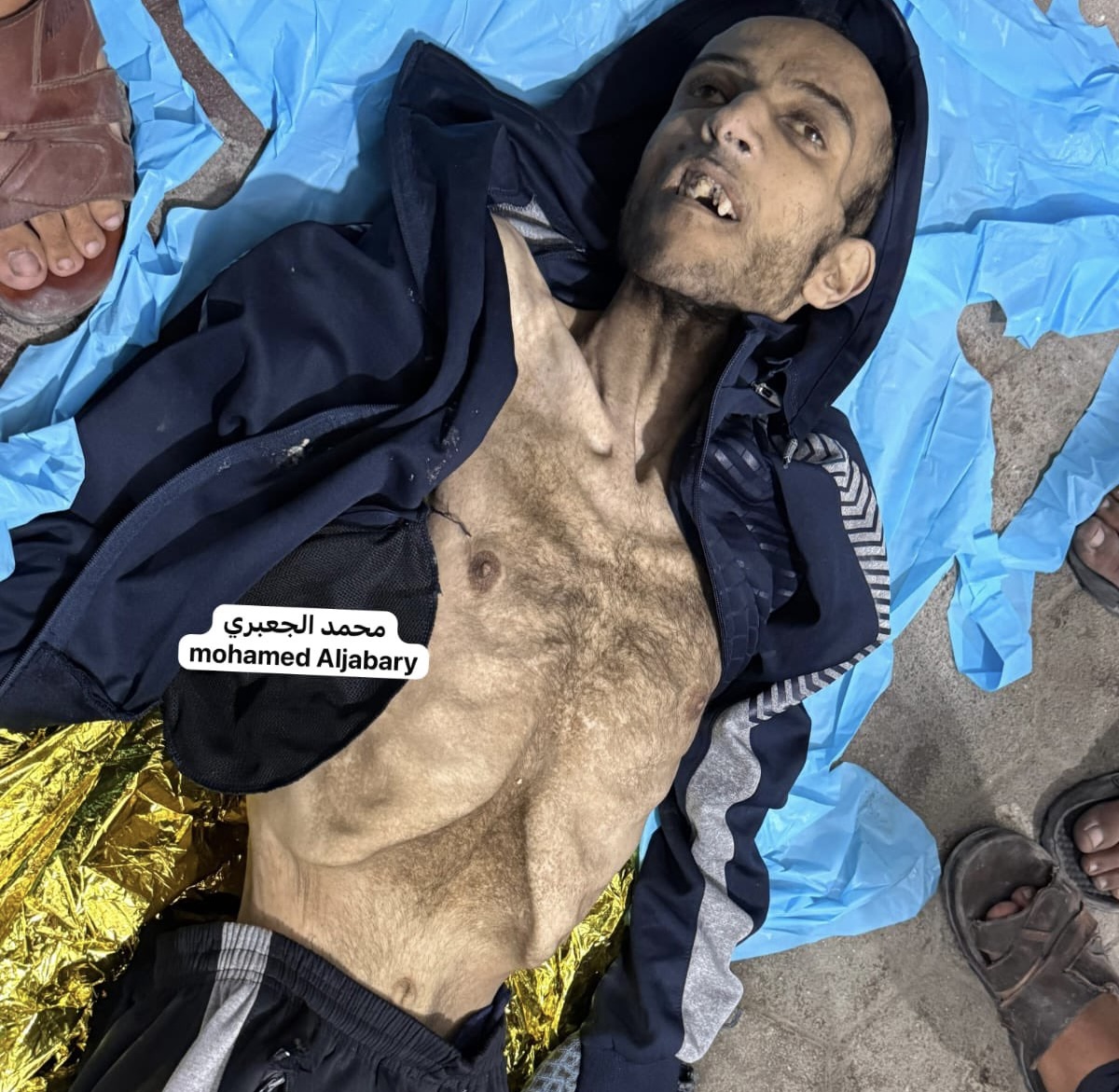 Palestinian with Special Needs Dies from Starvation in Gaza Amid Israeli Blockade