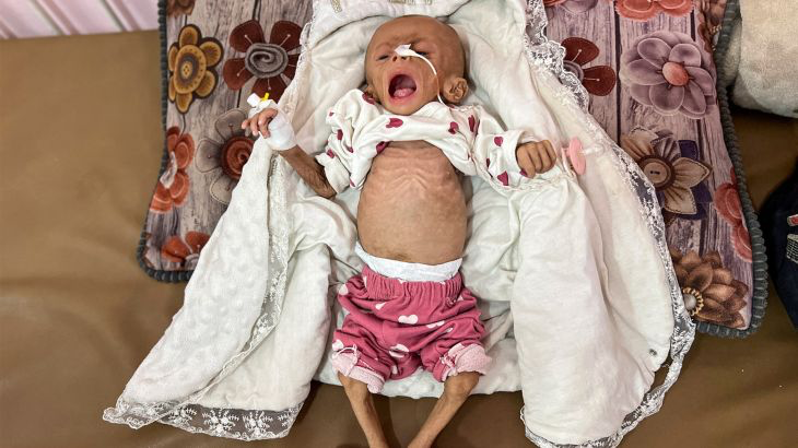 Gaza: 101 Have Died from Malnutrition and Starvation, Including 80 Children,  Amid Israeli Blockade