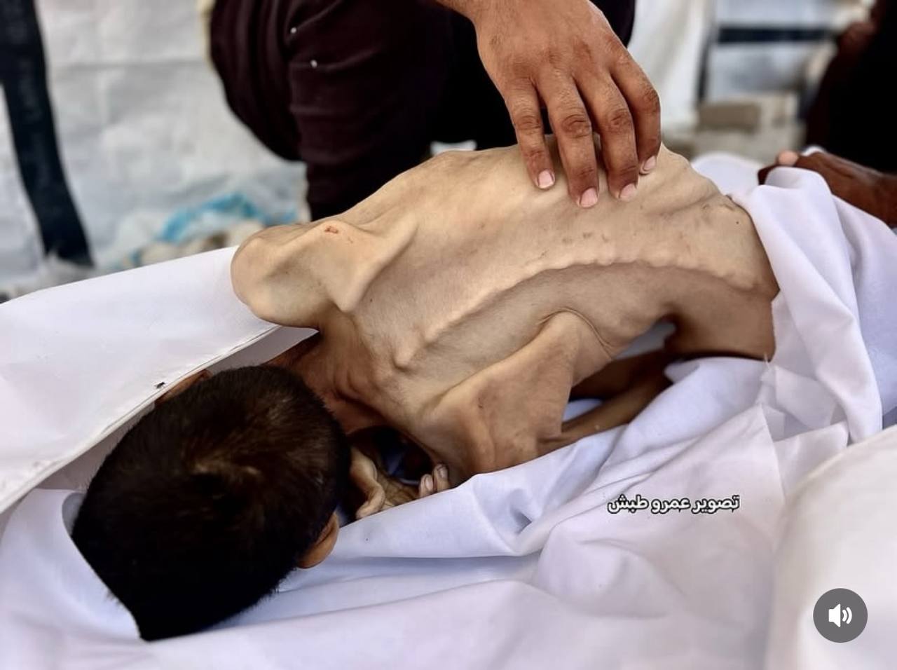 Another Palestinian Dies of Starvation Amid Israeli-Made Famine in Gaza