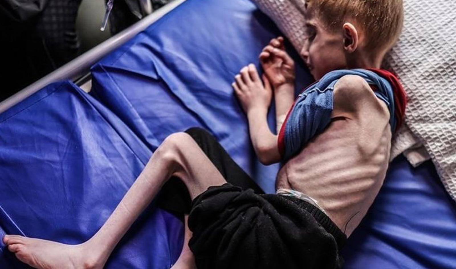 71 Children Died from Malnutrition in Gaza as Israeli Blockade on Aid Continues