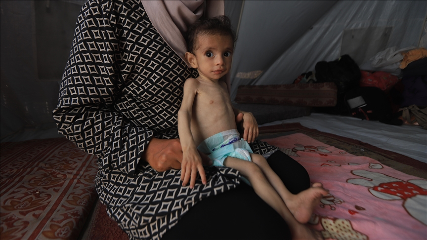 180 Died from Starvation and Malnutrition in Gaza Amid Israeli Blockade