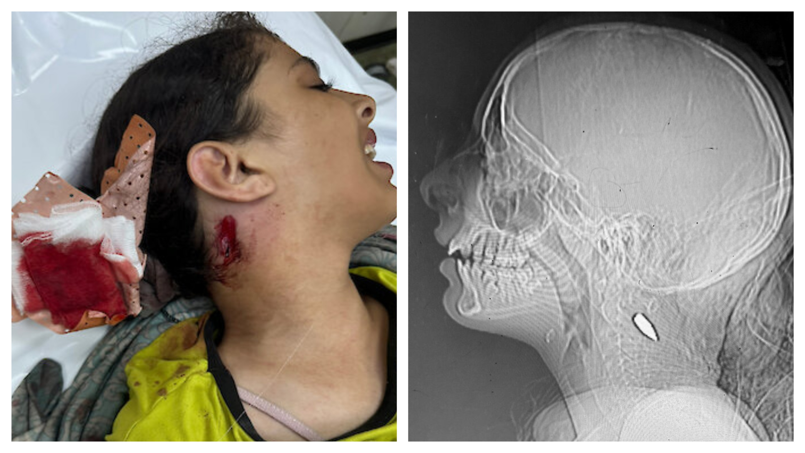 Foreign Doctors Uncover Disturbing Pattern of Israeli Forces Targeting Children in Gaza