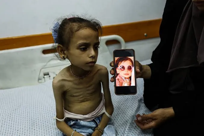 وزارة الصحة بغزة: 466 وفاة بسبب سوء التغذية والتجويع منذ 2024