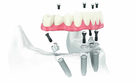 All on 4 implants
