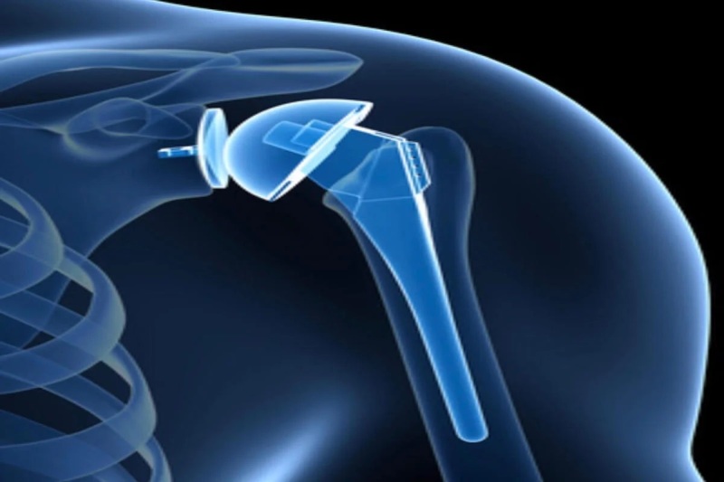 Anatomic_shoulder_replacement