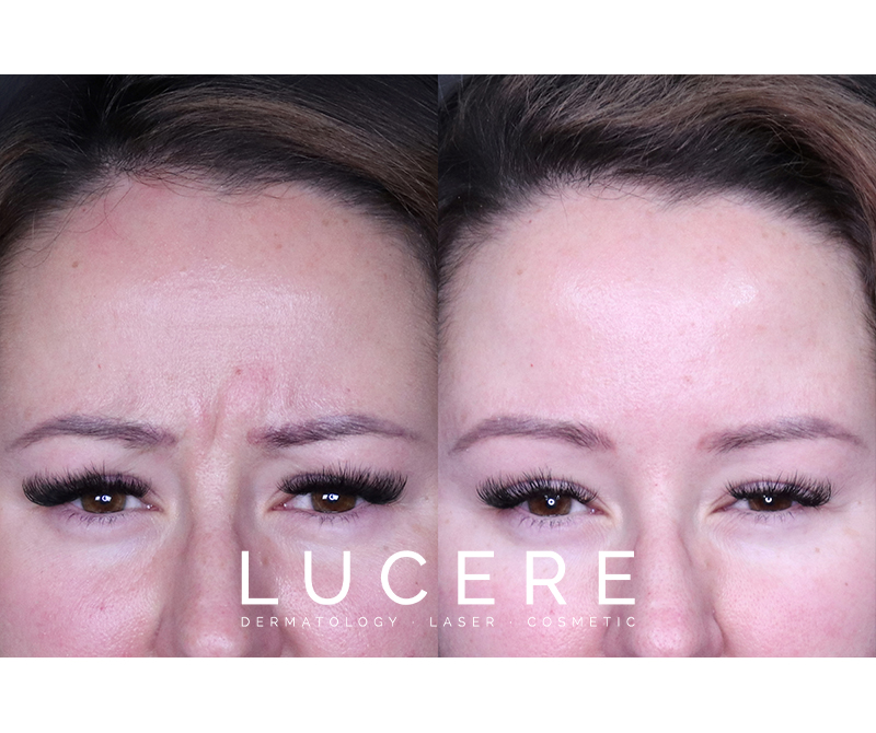 Botox Before and After