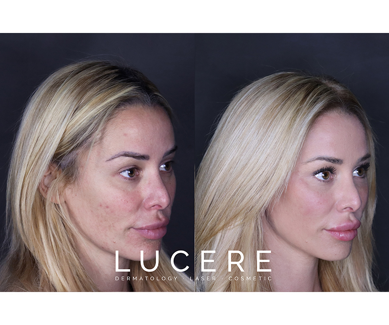 Cheek filler befoe and after