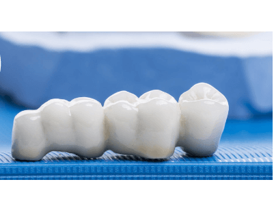 Dental Crowns - Bridges