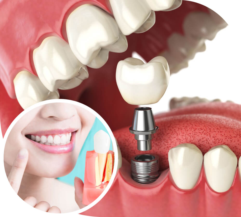 Dental Implants