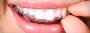 clear braces